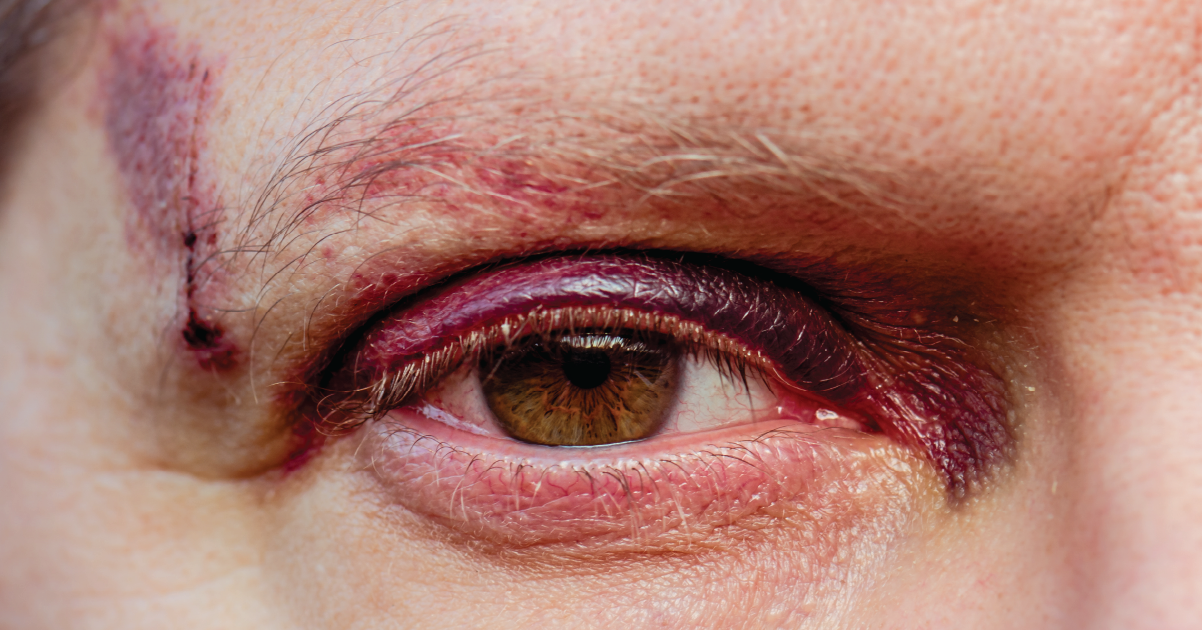 Can You Get a Concussion Without Hitting Your Head?